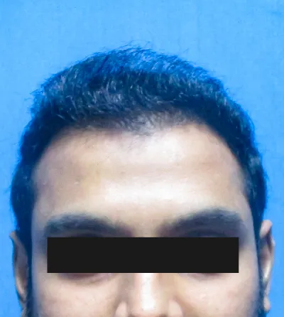 Activated Follicular Transplant Result After in VCare